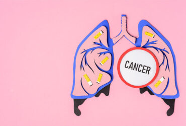 Lung Cancer