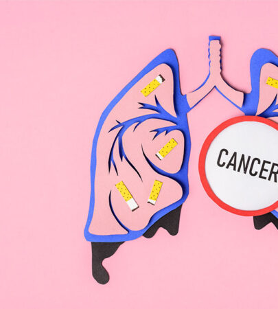 Lung Cancer